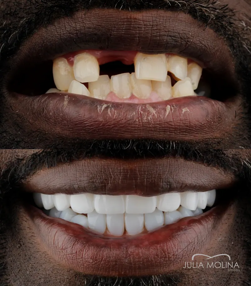 Before and after dental treatment in Colombia, case 01, Smiles by Julia Molina