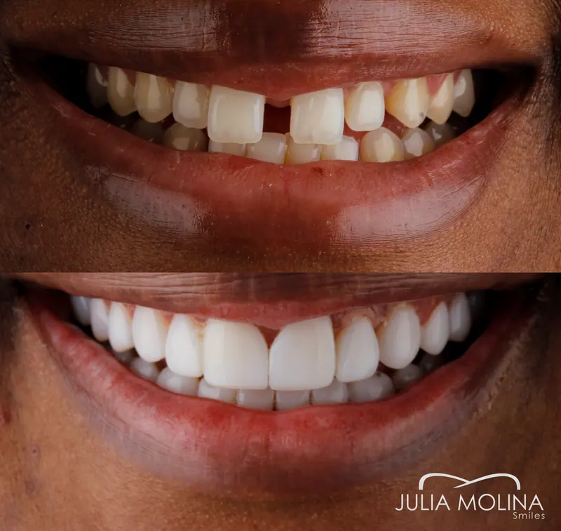 Before and after dental treatment in Colombia, case 10, Smiles by Julia Molina