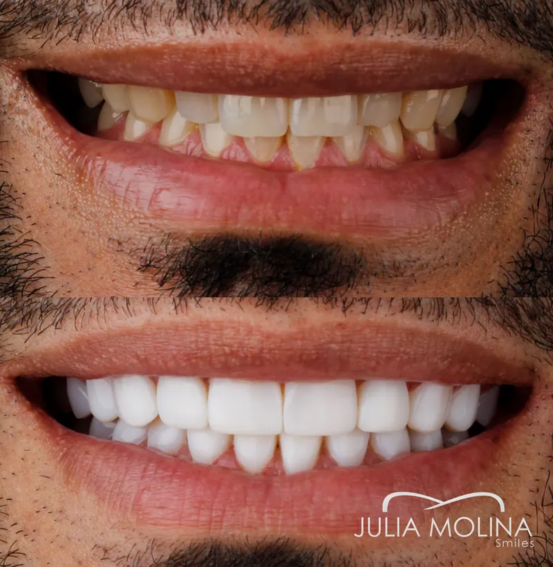 Before and after dental treatment in Colombia, case 11, Smiles by Julia Molina