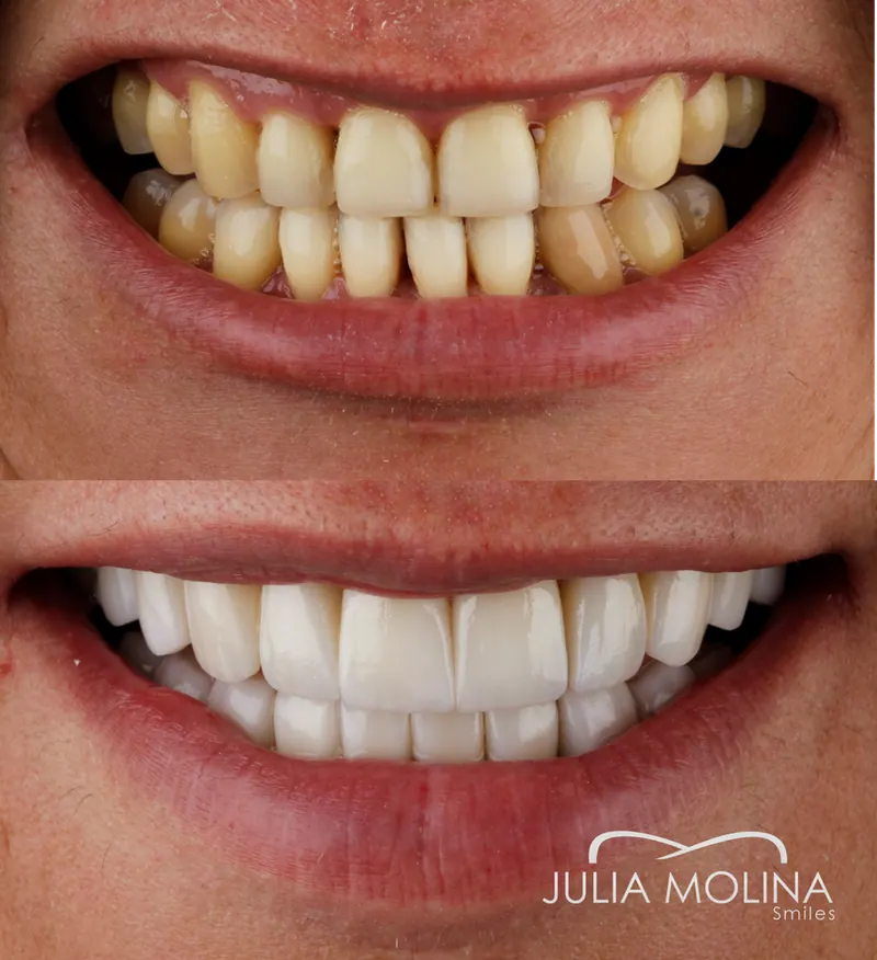 Before and after dental treatment in Colombia, case 12, Smiles by Julia Molina