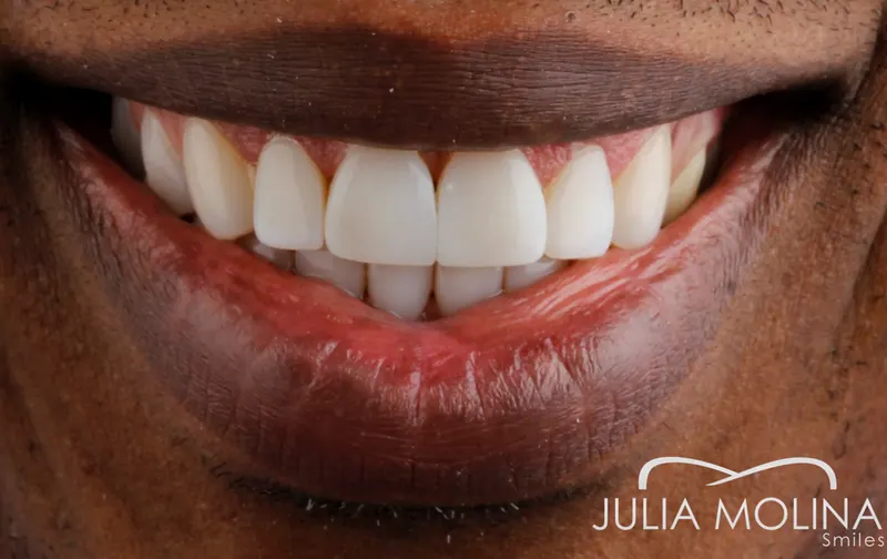 Before and after dental treatment in Colombia, case 13, Smiles by Julia Molina