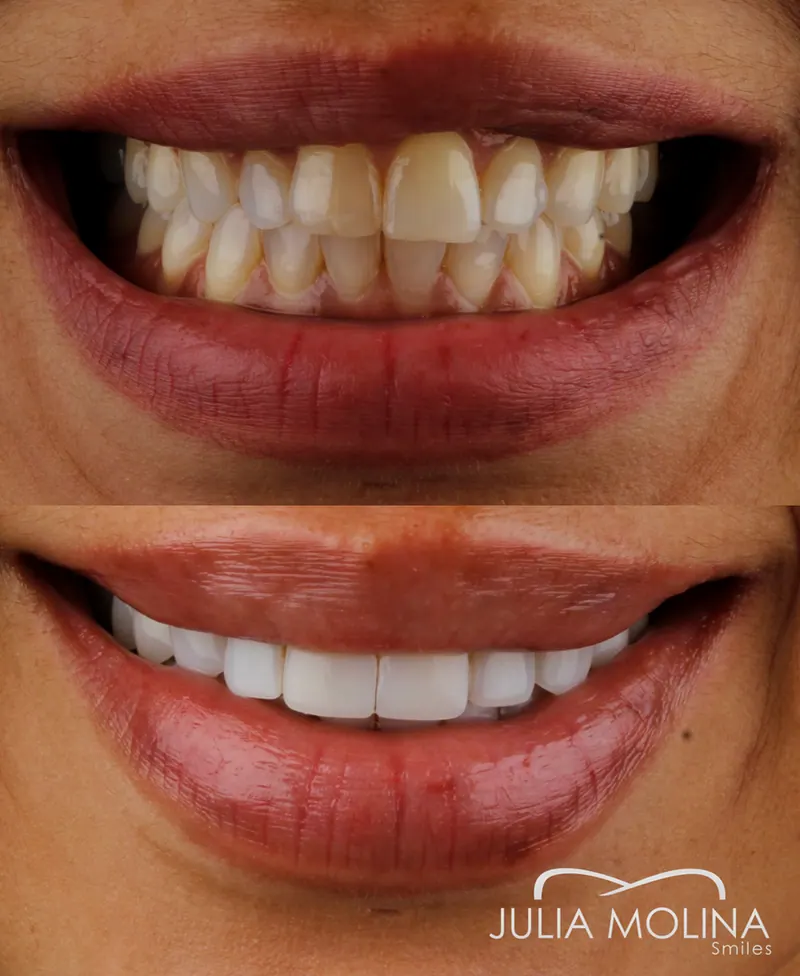 Before and after dental treatment in Colombia, case 14, Smiles by Julia Molina