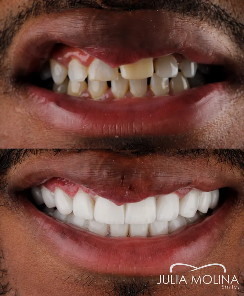 Before and after dental treatment in Colombia, case 15, Smiles by Julia Molina