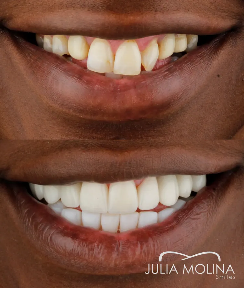 Before and after dental treatment in Colombia, case 16, Smiles by Julia Molina