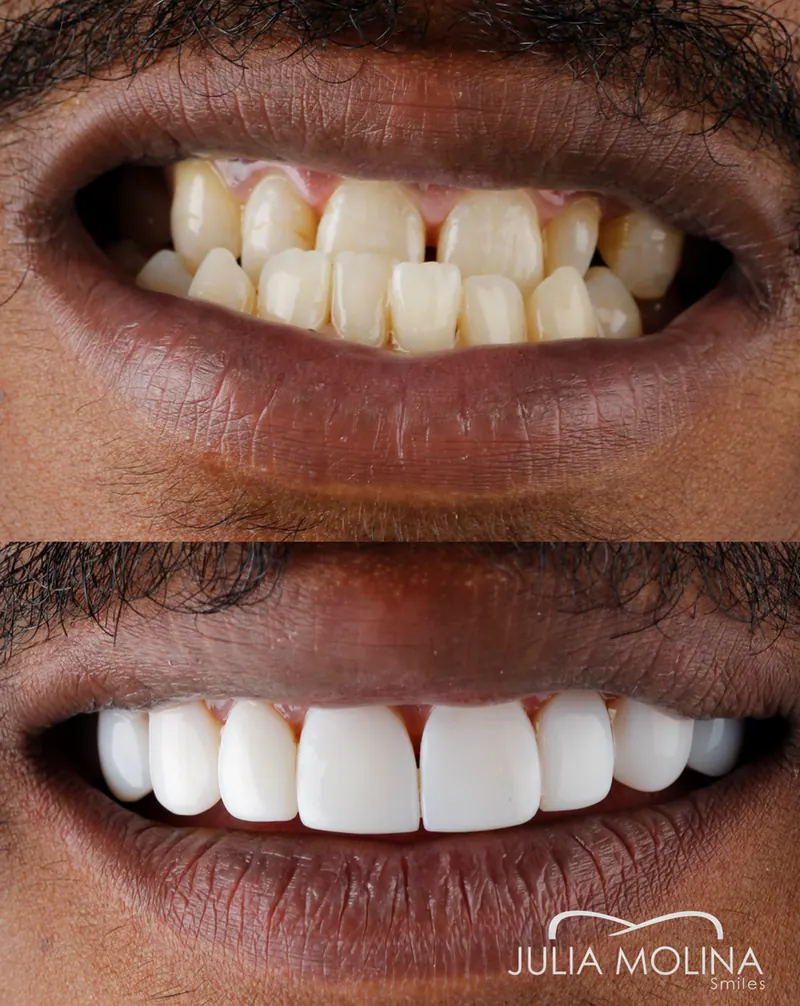 Before and after dental treatment in Colombia, case 18, Smiles by Julia Molina
