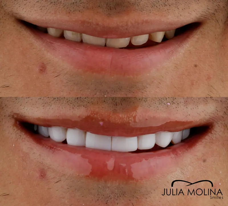 Before and after dental treatment in Colombia, case 02, Smiles by Julia Molina
