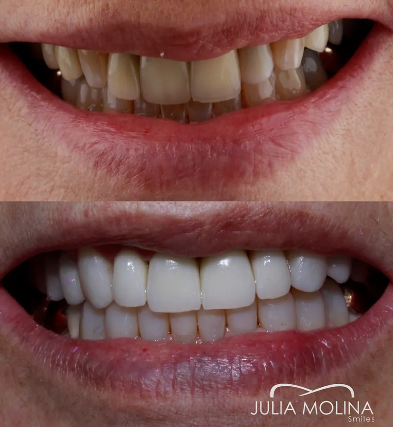 Before and after dental treatment in Colombia, case 19, Smiles by Julia Molina