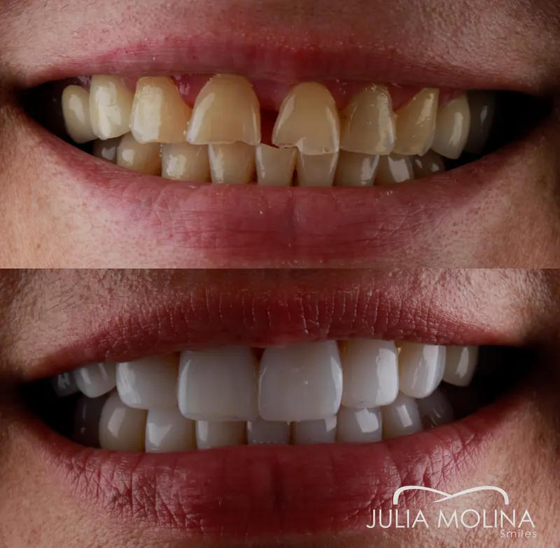 Before and after dental treatment in Colombia, case 20, Smiles by Julia Molina