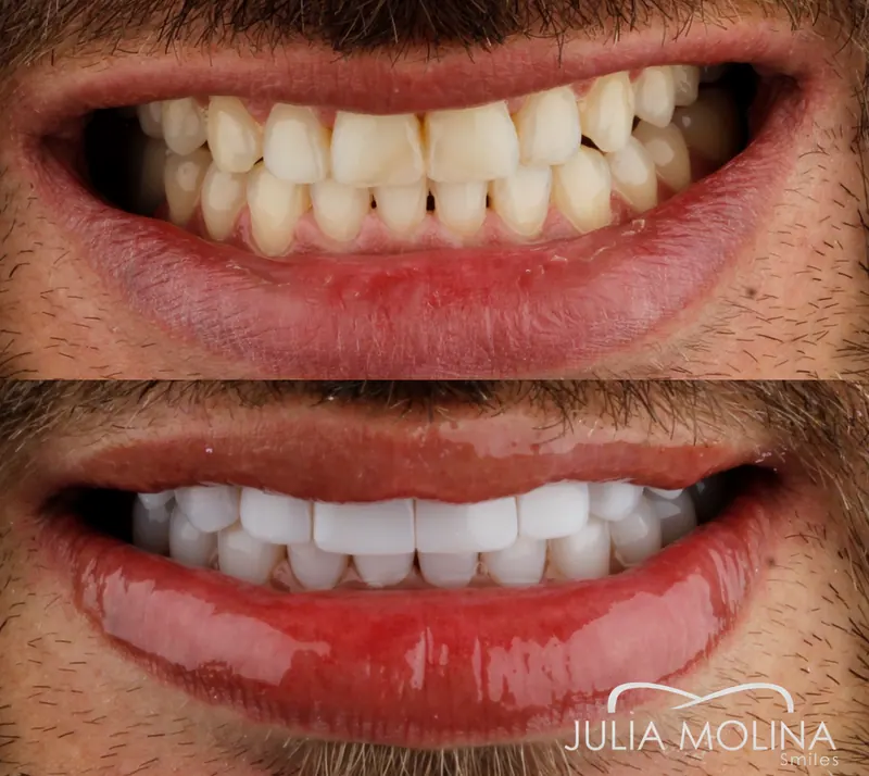 Before and after dental treatment in Colombia, case 22, Smiles by Julia Molina