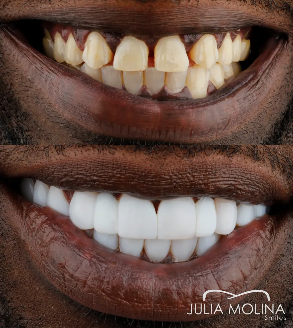 Complete smile makeover before and after in Colombia