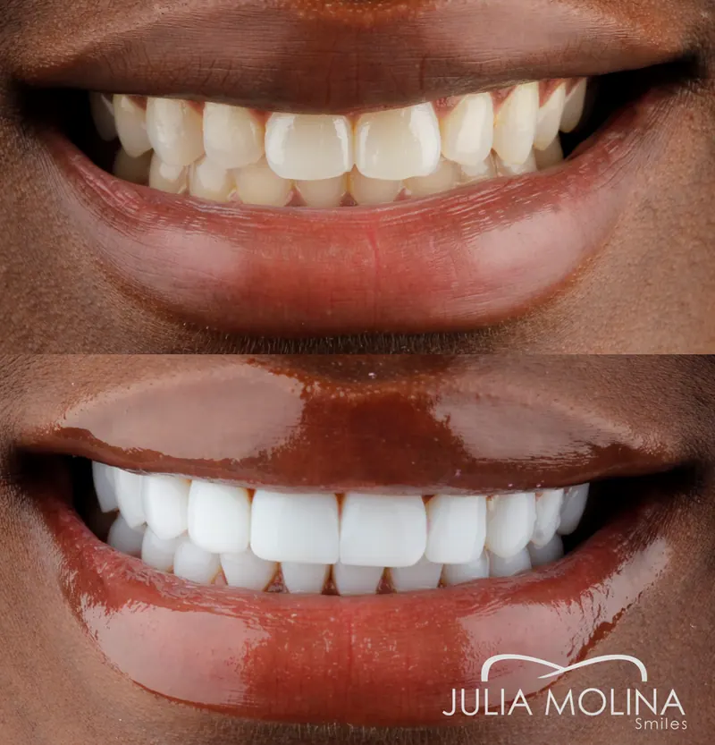 Before and after dental treatment in Colombia, case 25, Smiles by Julia Molina