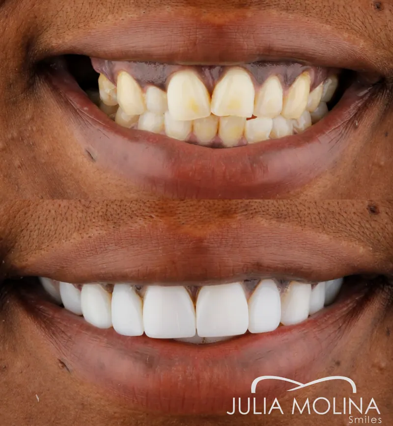 Before and after dental treatment in Colombia, case 26, Smiles by Julia Molina