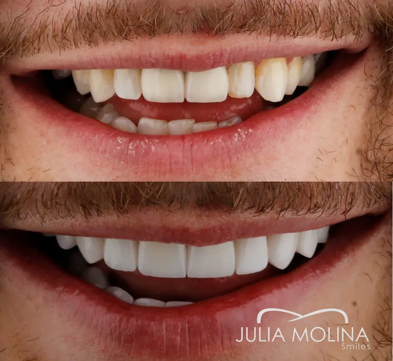 Before and after dental treatment in Colombia, case 27, Smiles by Julia Molina
