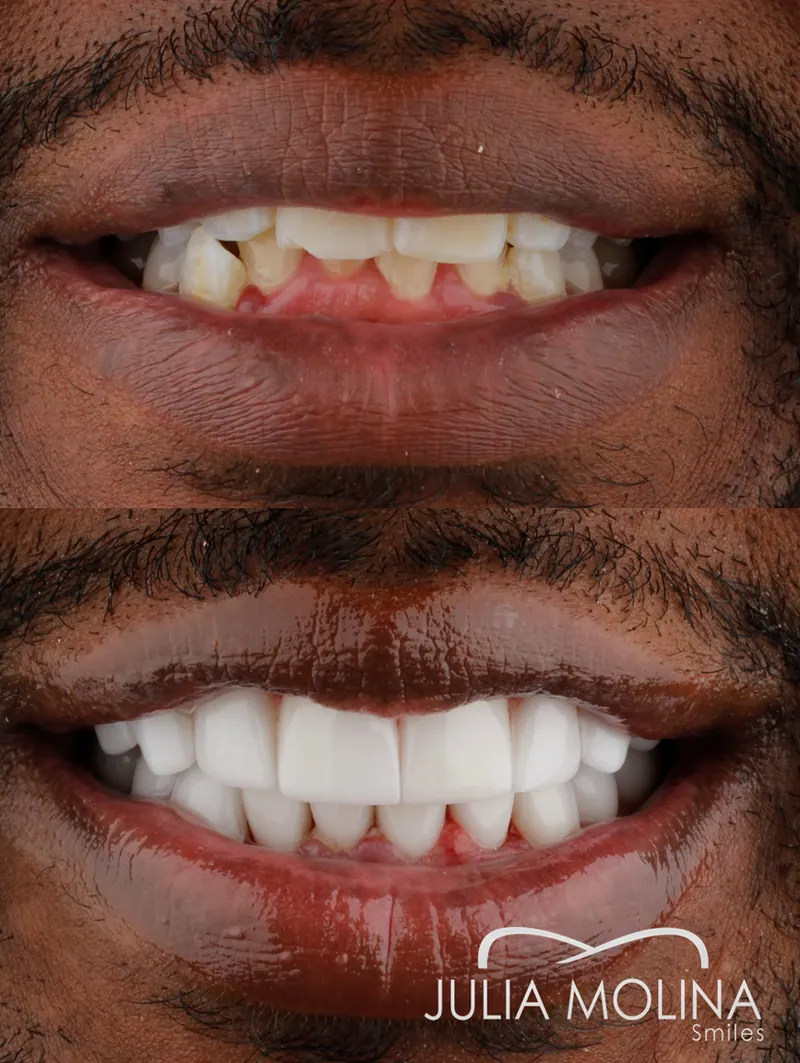 Before and after dental treatment in Colombia, case 28, Smiles by Julia Molina