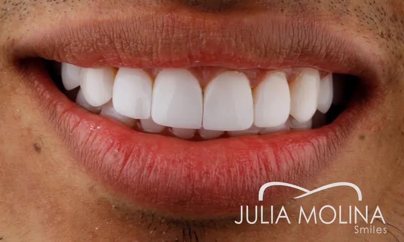 Before and after dental treatment in Colombia, case 29, Smiles by Julia Molina