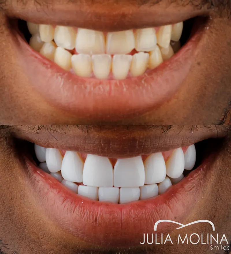 Before and after dental treatment in Colombia, case 30, Smiles by Julia Molina