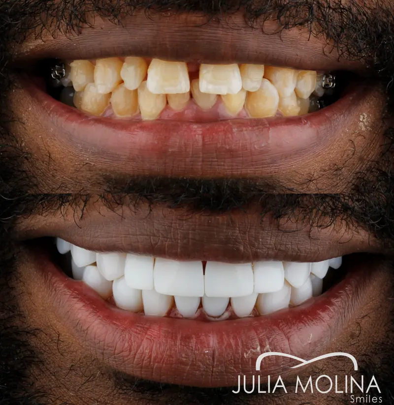 Before and after dental treatment in Colombia, case 31, Smiles by Julia Molina