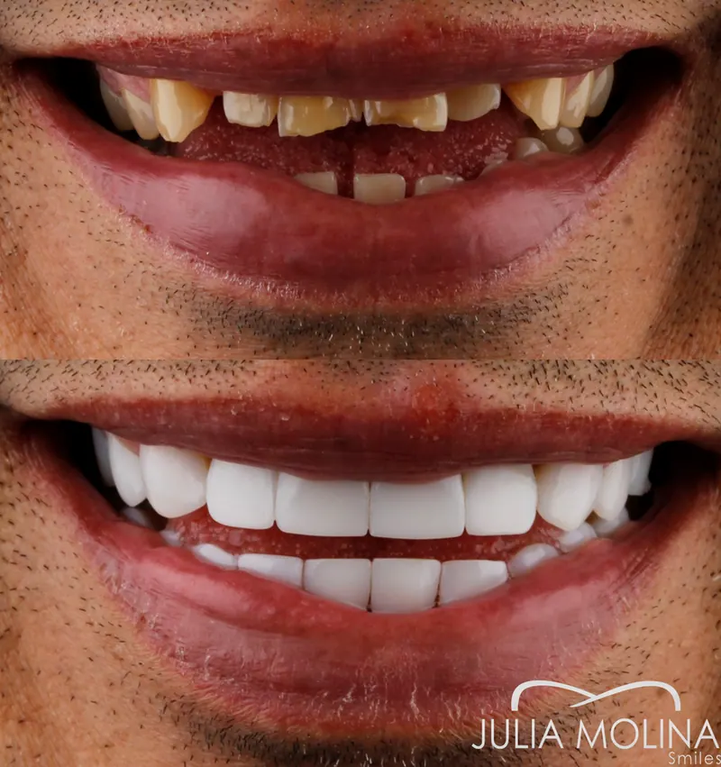 Before and after dental treatment in Colombia, case 32, Smiles by Julia Molina