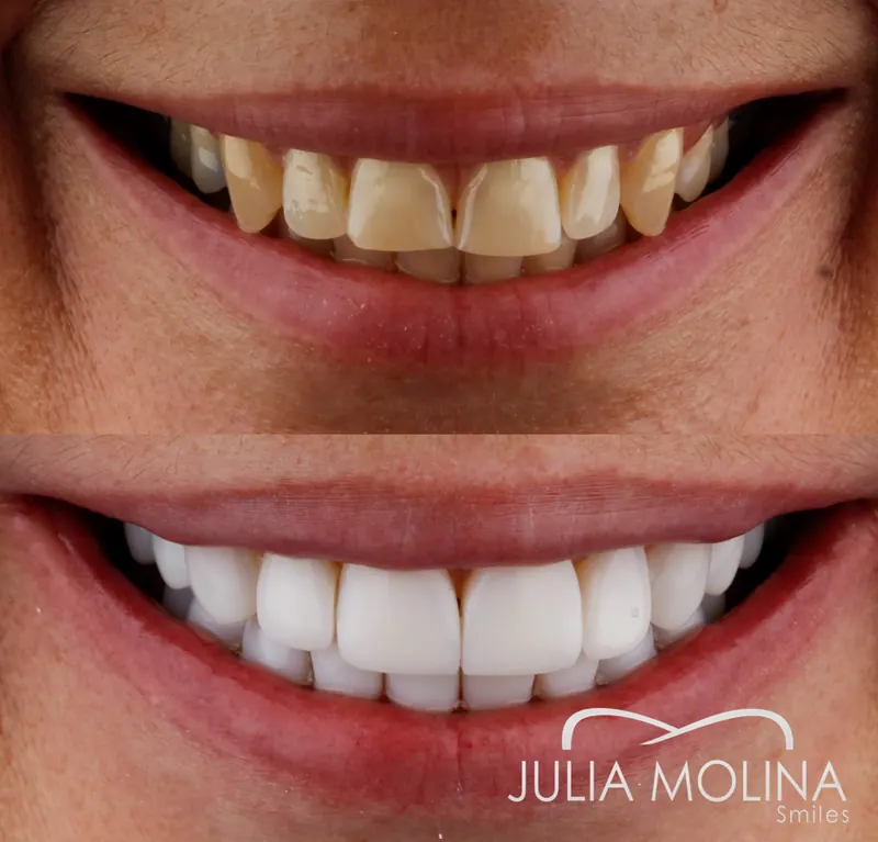 Before and after dental treatment in Colombia, case 33, Smiles by Julia Molina