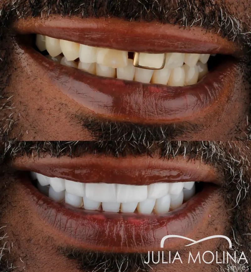 Before and after dental treatment in Colombia, case 34, Smiles by Julia Molina