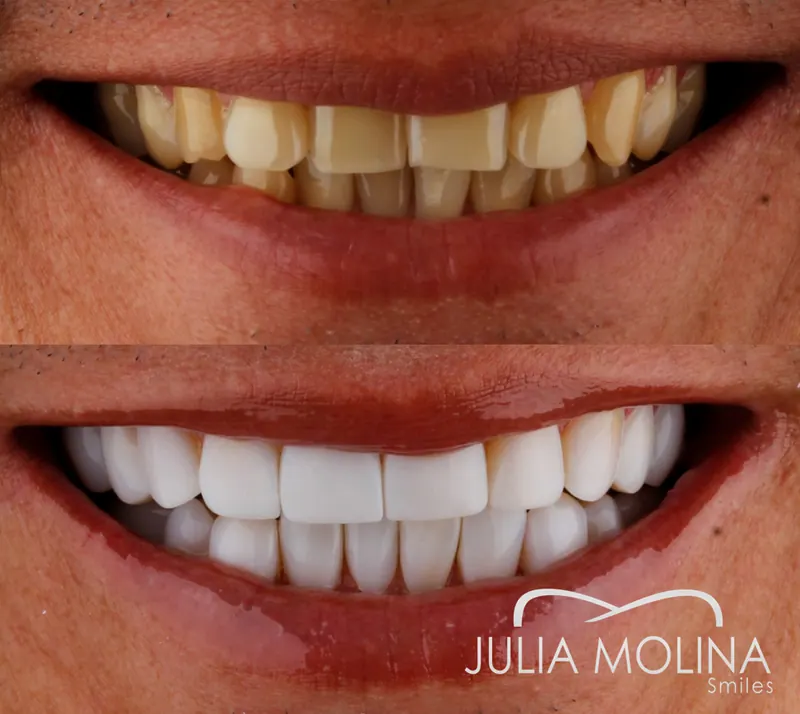 Before and after dental treatment in Colombia, case 35, Smiles by Julia Molina