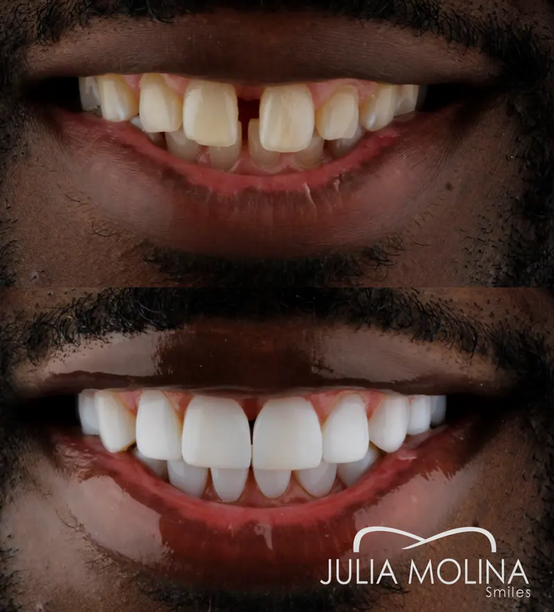 Before and after dental treatment in Colombia, case 36, Smiles by Julia Molina