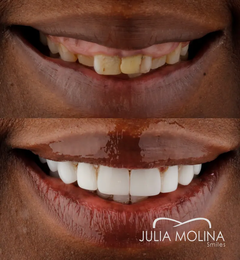Before and after dental treatment in Colombia, case 37, Smiles by Julia Molina