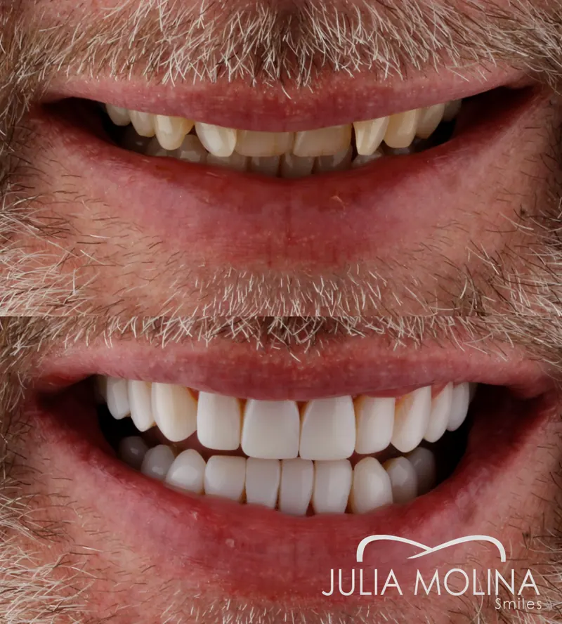Before and after dental treatment in Colombia, case 38, Smiles by Julia Molina