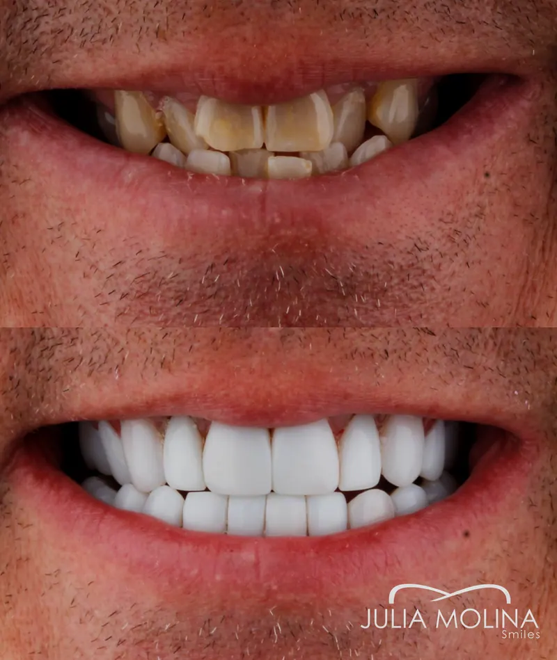 Before and after dental treatment in Colombia, case 04, Smiles by Julia Molina