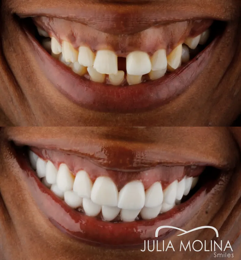 Before and after dental treatment in Colombia, case 39, Smiles by Julia Molina