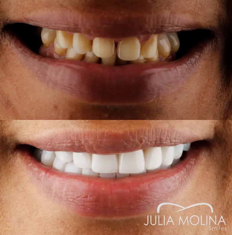 Before and after dental treatment in Colombia, case 40, Smiles by Julia Molina