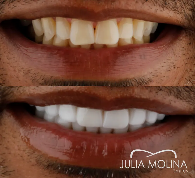 Before and after dental treatment in Colombia, case 41, Smiles by Julia Molina