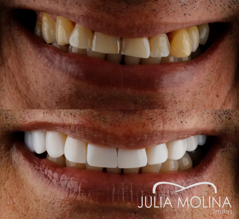 Before and after dental treatment in Colombia, case 42, Smiles by Julia Molina