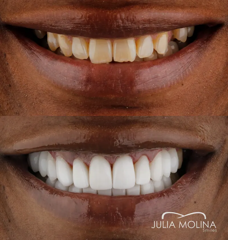 Before and after dental treatment in Colombia, case 05, Smiles by Julia Molina
