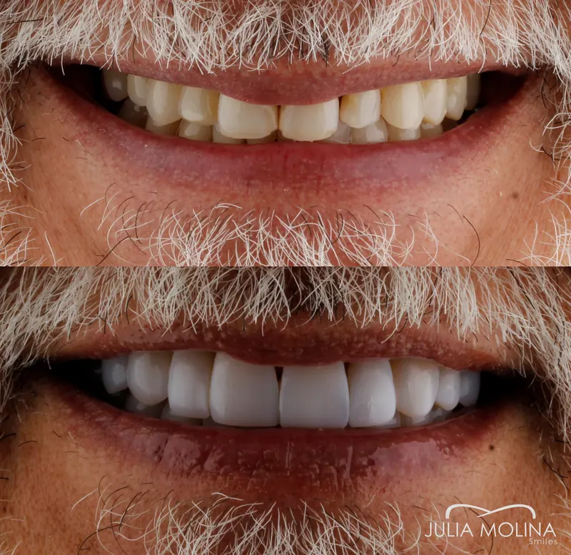 Before and after dental treatment in Colombia, case 06, Smiles by Julia Molina
