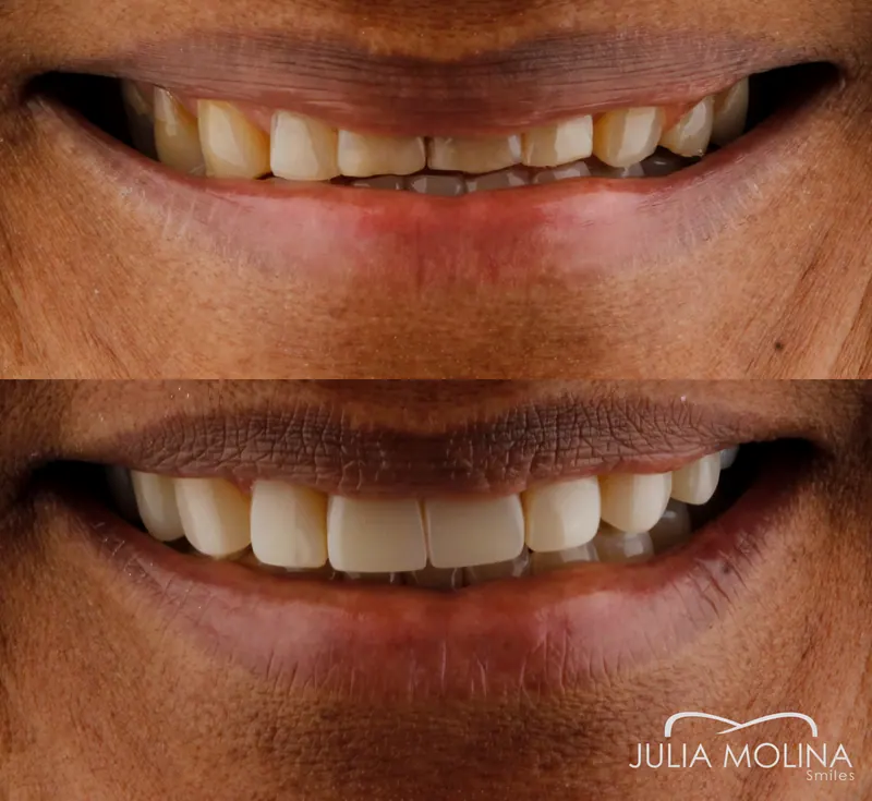 Before and after dental treatment in Colombia, case 07, Smiles by Julia Molina
