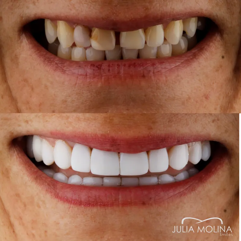 Before and after dental treatment in Colombia, case 08, Smiles by Julia Molina