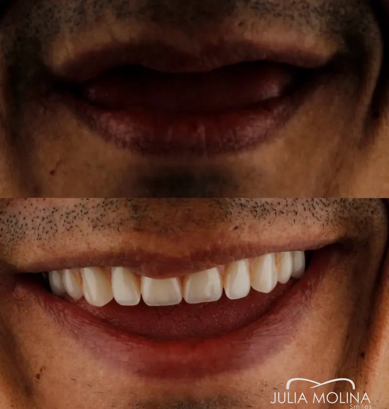 Before and after dental treatment in Colombia, case 09, Smiles by Julia Molina