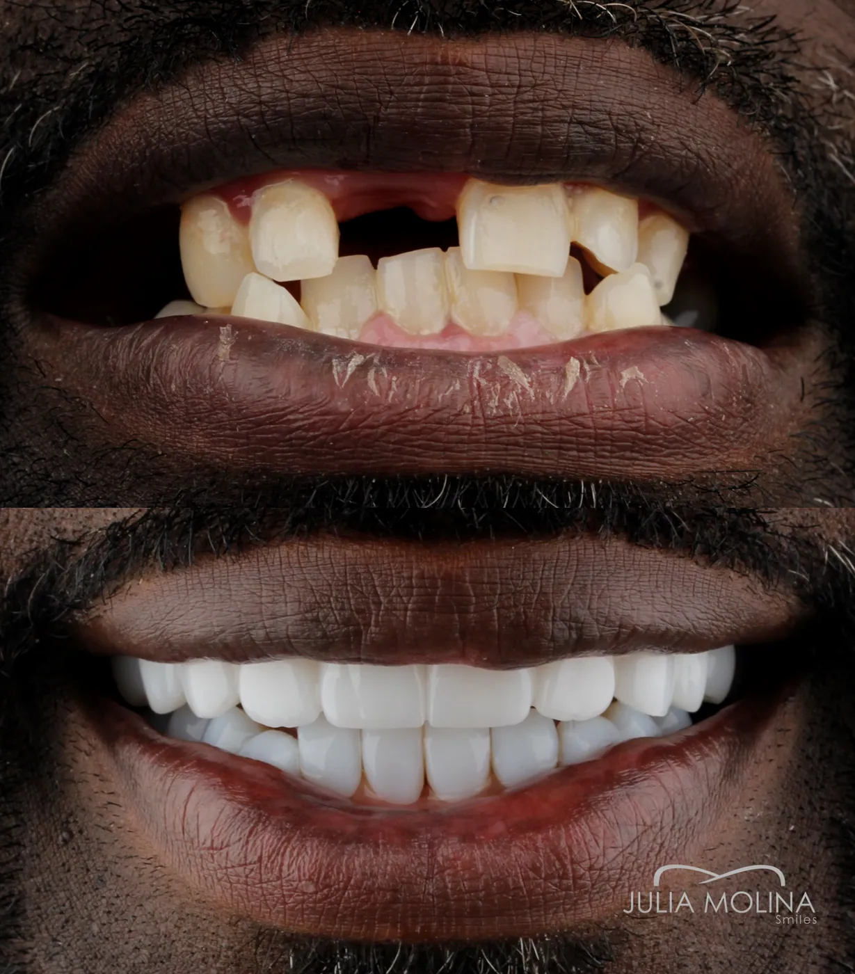 Dental implants before and after with natural-looking results in Colombia