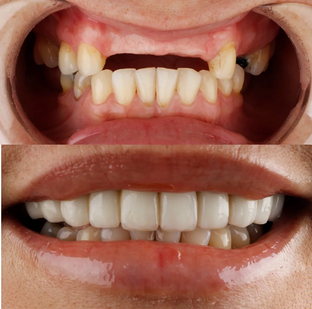 Missing teeth replaced with dental implants in Pereira, Colombia