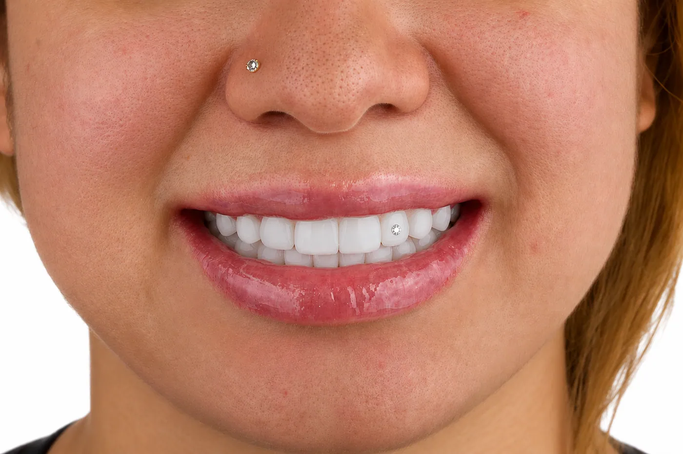 Dental jewelry: small diamond placed on the tooth surface in Colombia