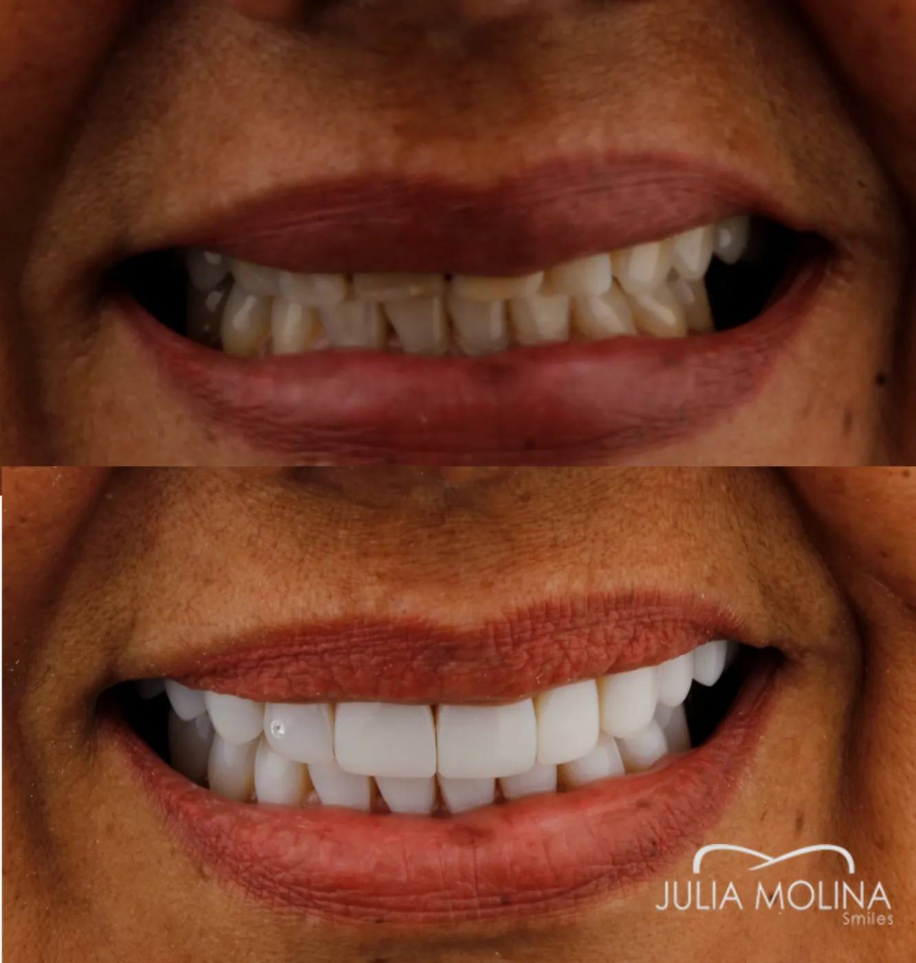 Veneers before and after in Colombia, Smiles by Julia Molina