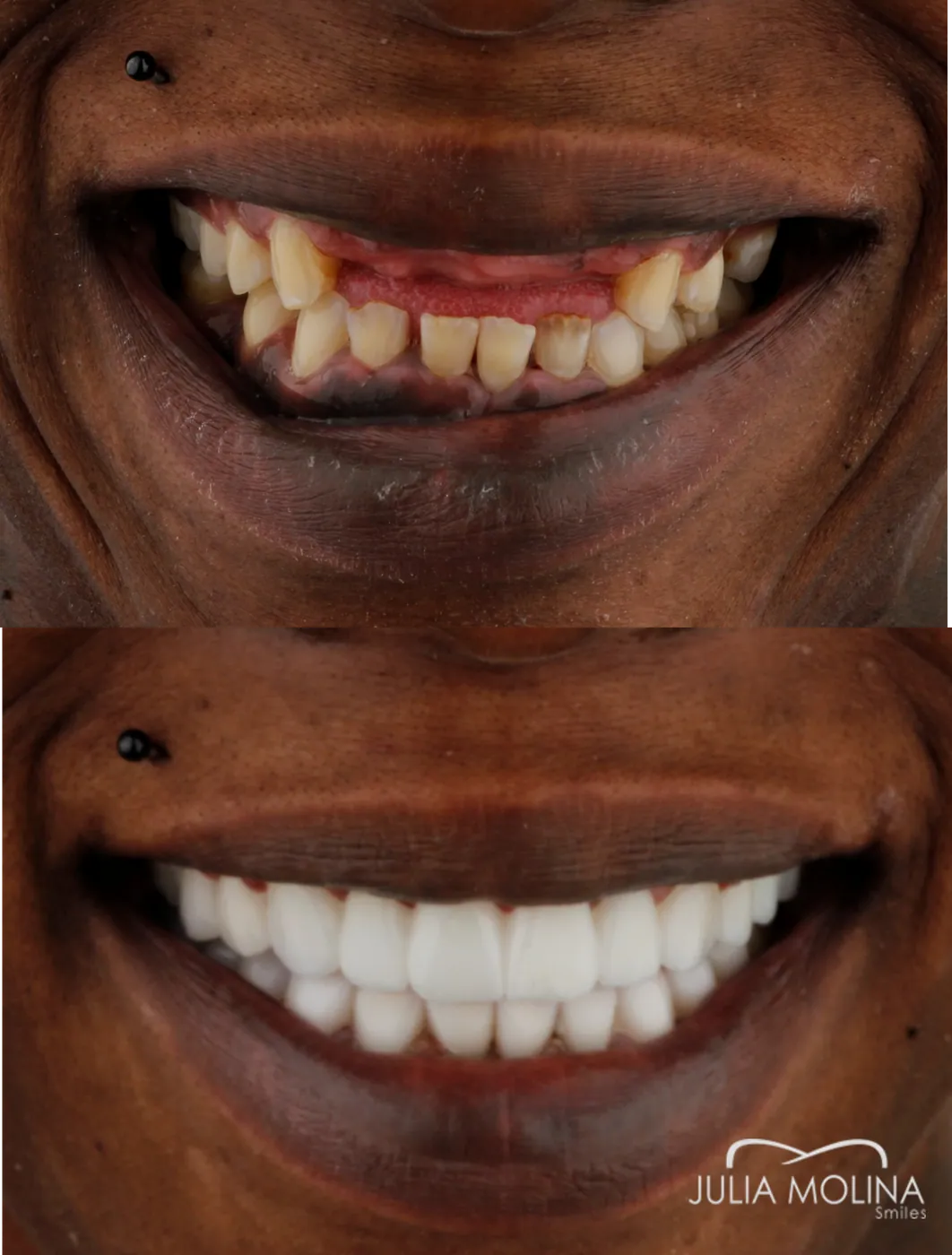 Dental veneers smile makeover before and after in Colombia
