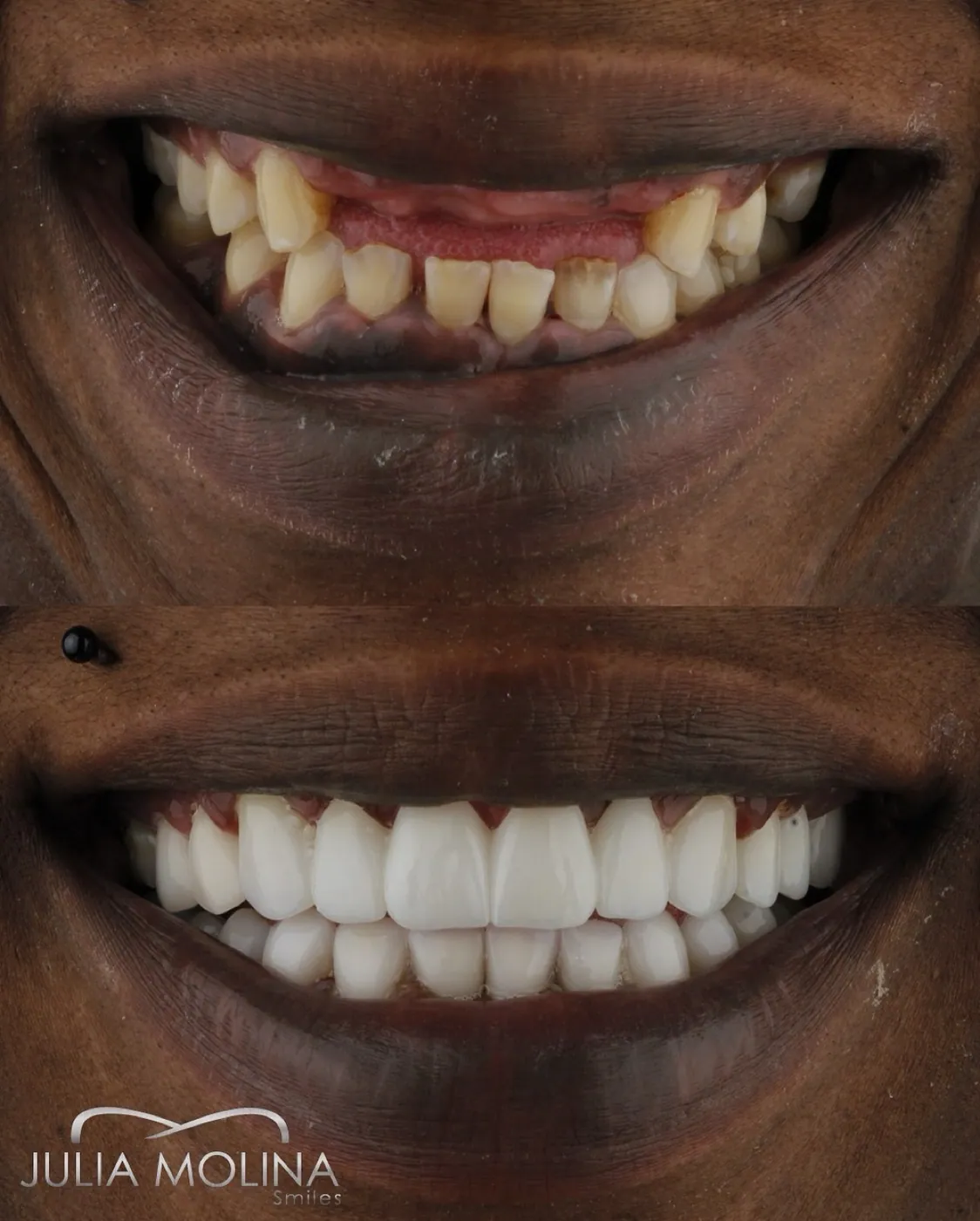 Full mouth restoration before and after in Colombia