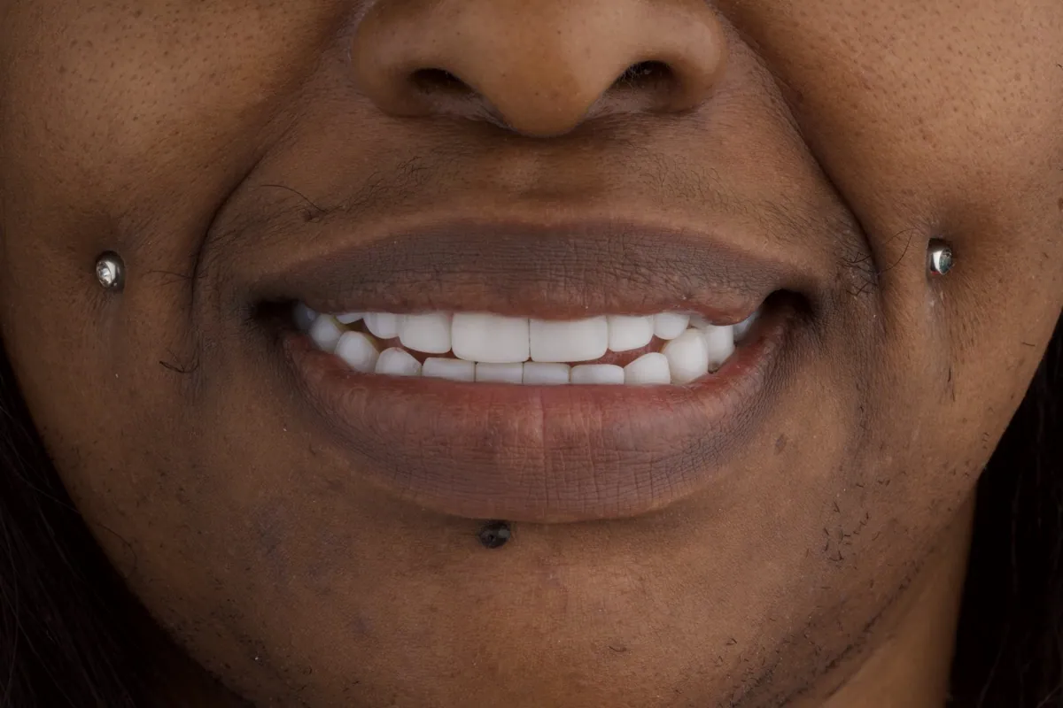 Smile after dental treatment in Colombia