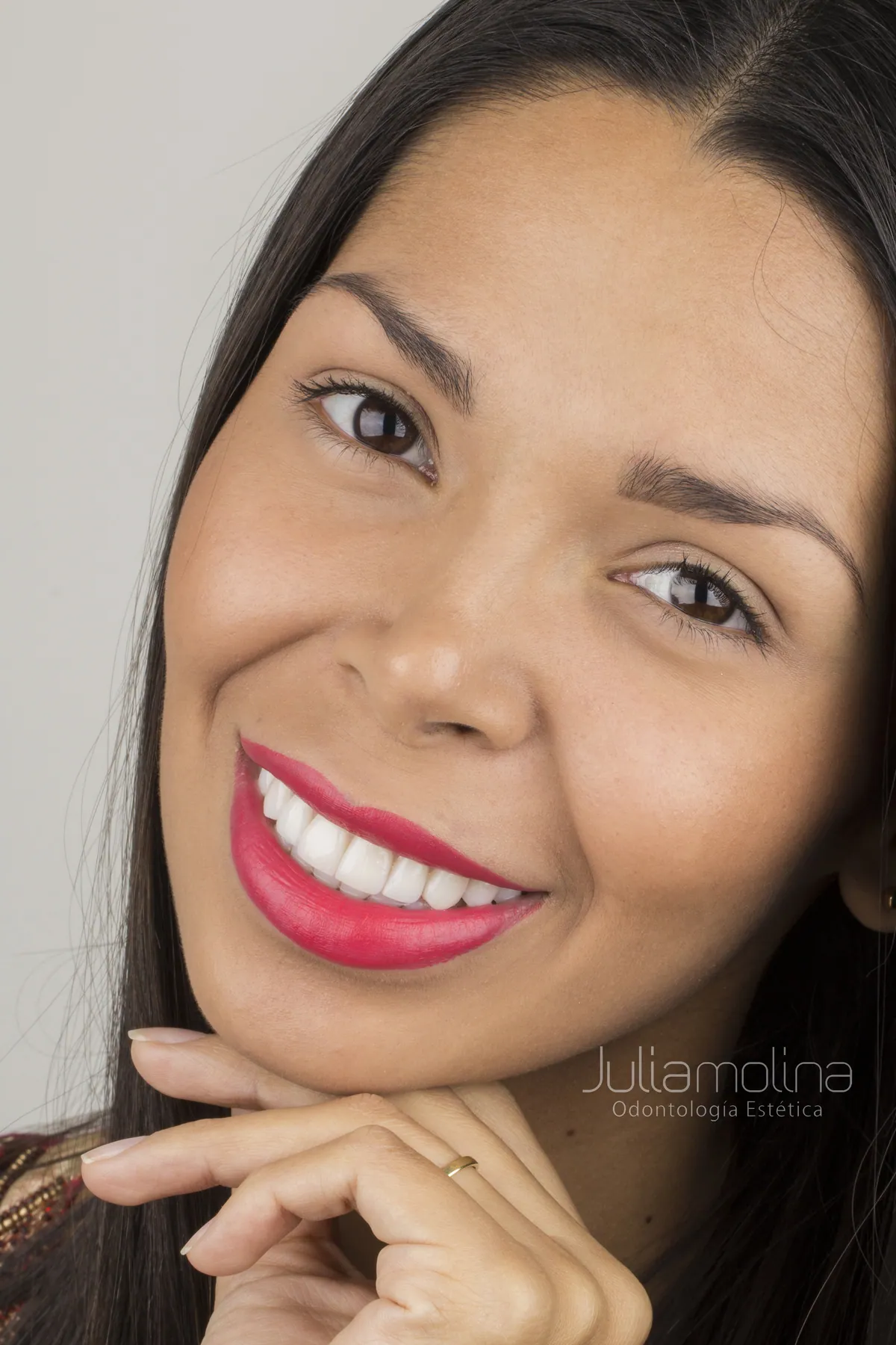 Patient smiling after smile design in Colombia