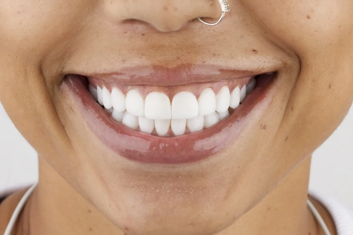 Bright, natural smile after veneers in Colombia