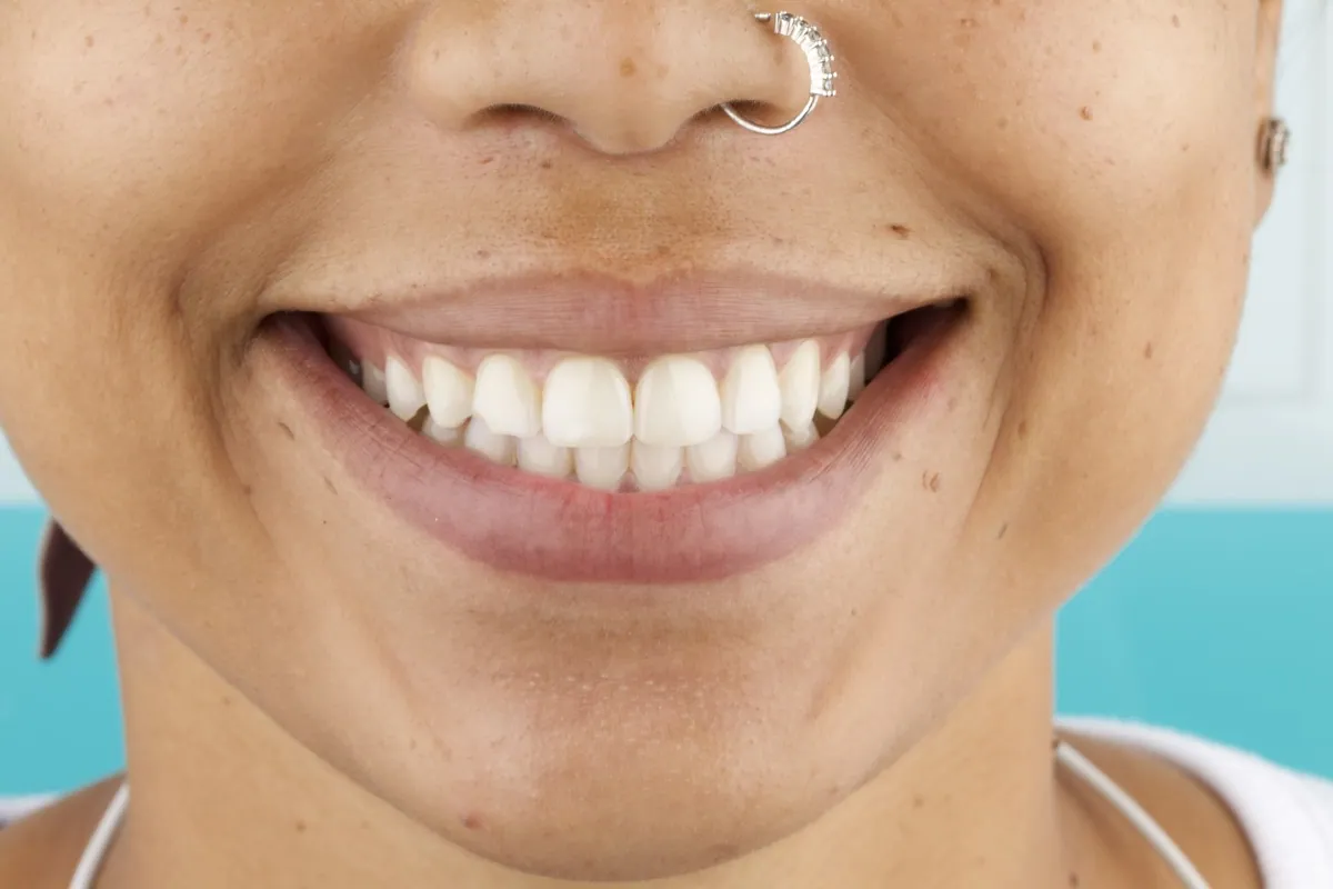 Smile before porcelain veneers